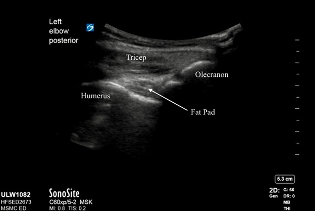 Ultrasound image demonstrating normal anatomy of the elbow with the probe marker in a cephalad and longitudinal position along the posterior aspect of the elbow.  The patient’s elbow should be positioned in flexion to 90 degrees to get this image.   Labels demonstrate the triceps muscle / tendon, olecranon, humerus, and fat pad.  In this view an effusion would be located below the fat pad in between the humerus and olecranon.