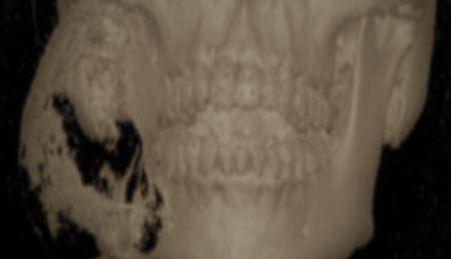 Fig. 2: CT of solid ameloblastoma of the mandible