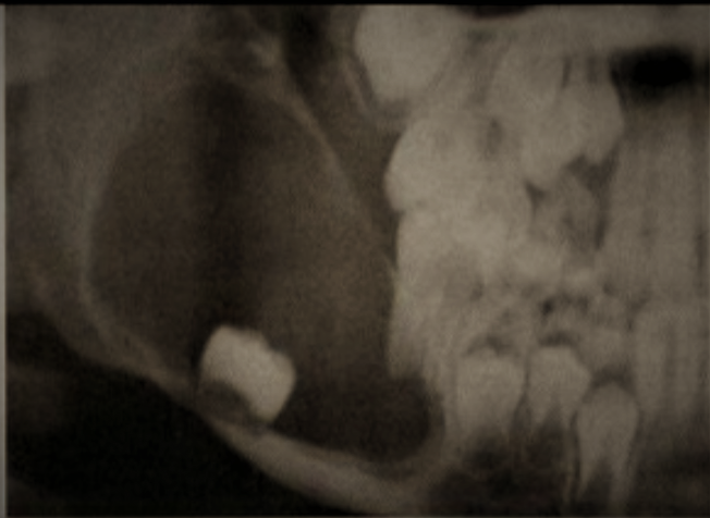 Fig. 3: OPG of unicystic ameloblastoma of the mandible