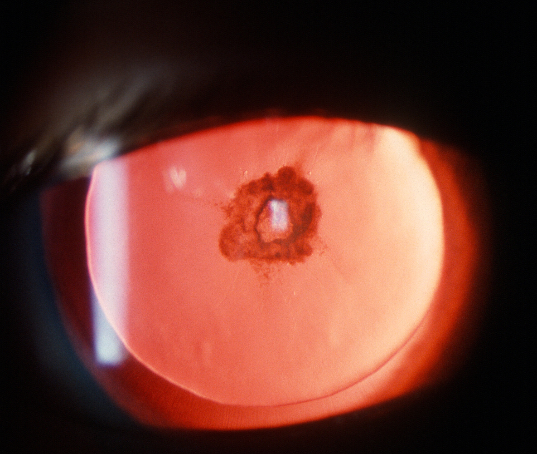 Posterior subcapsular cataract seen after chronic steroid use