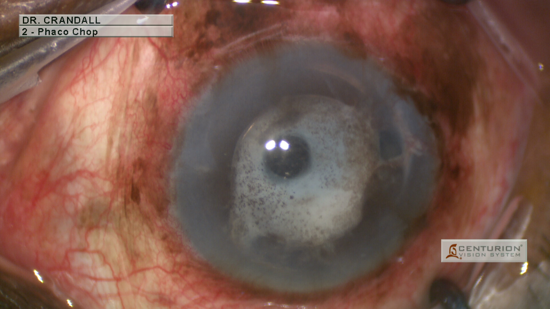 Inflamed cocoon anterior chamber IOL secondary to Uveitis-Glaucoma-Hyphema syndrome (UGH syndrome): UGH syndrome is a rare condition that classically presents with uveitis, glaucoma, and hyphema in the setting of an anterior chamber IOL
