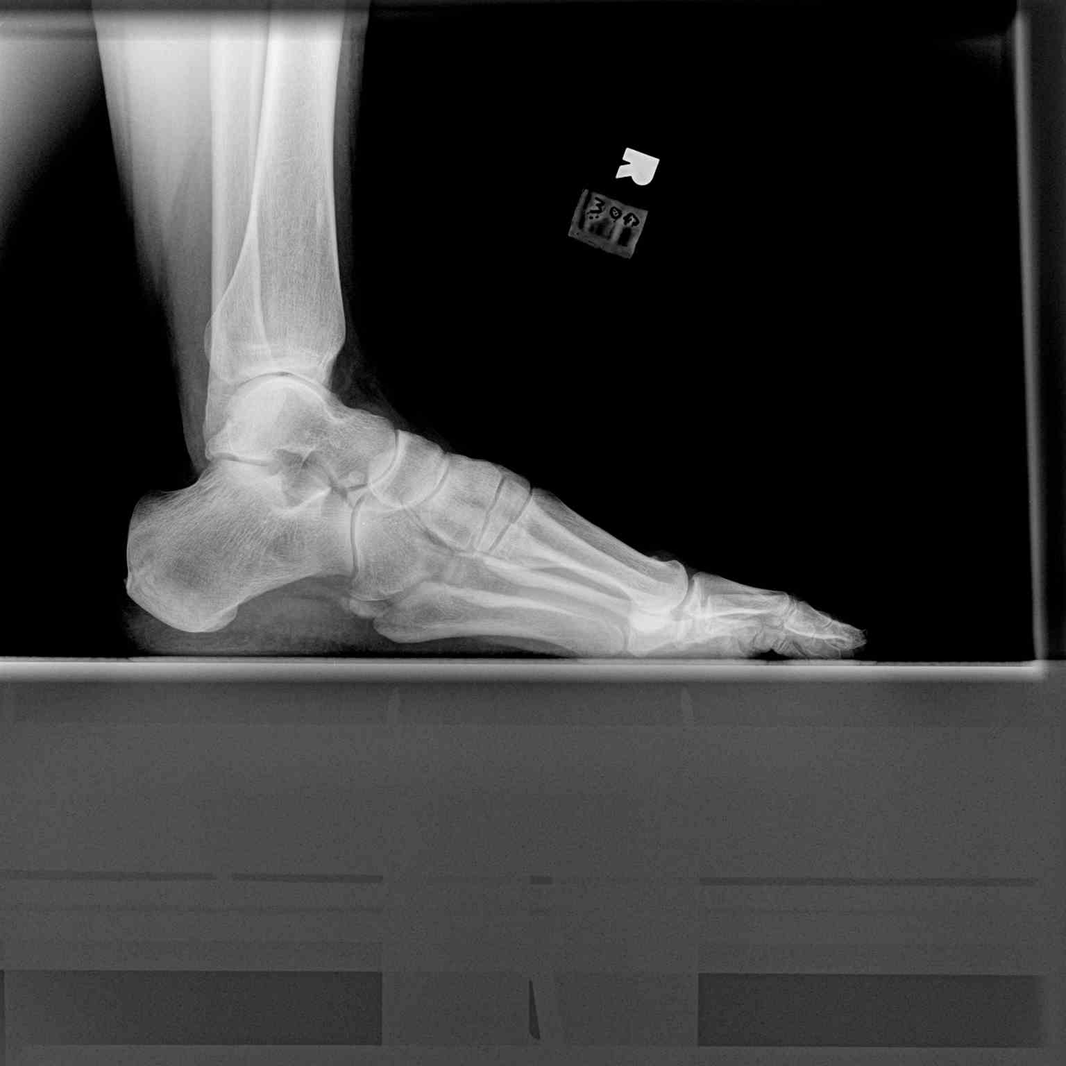 <p>Lateral Ankle Radiograph, Os Peroneum</p>