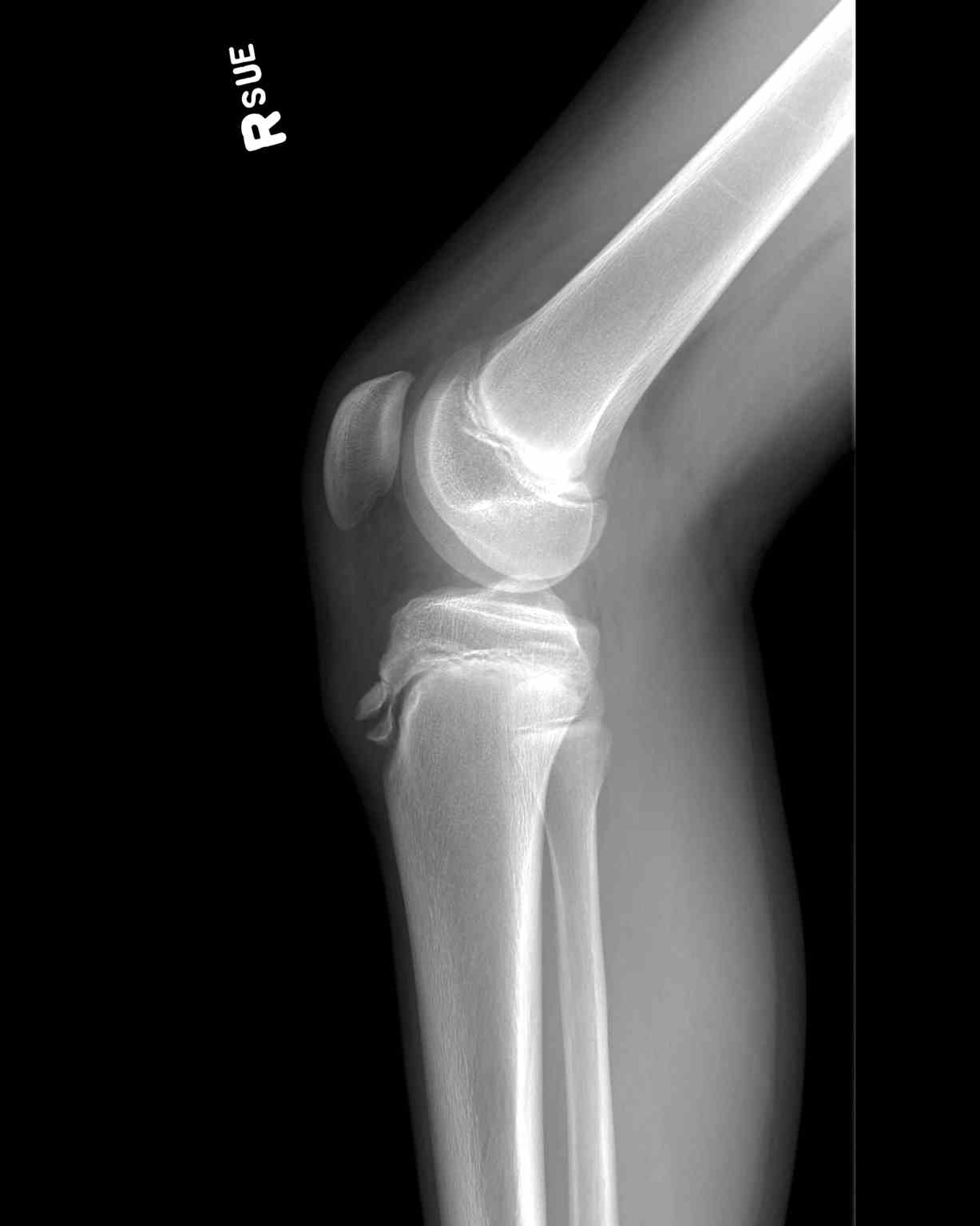 Lateral Knee Radiograph Osgood Slatter Disease