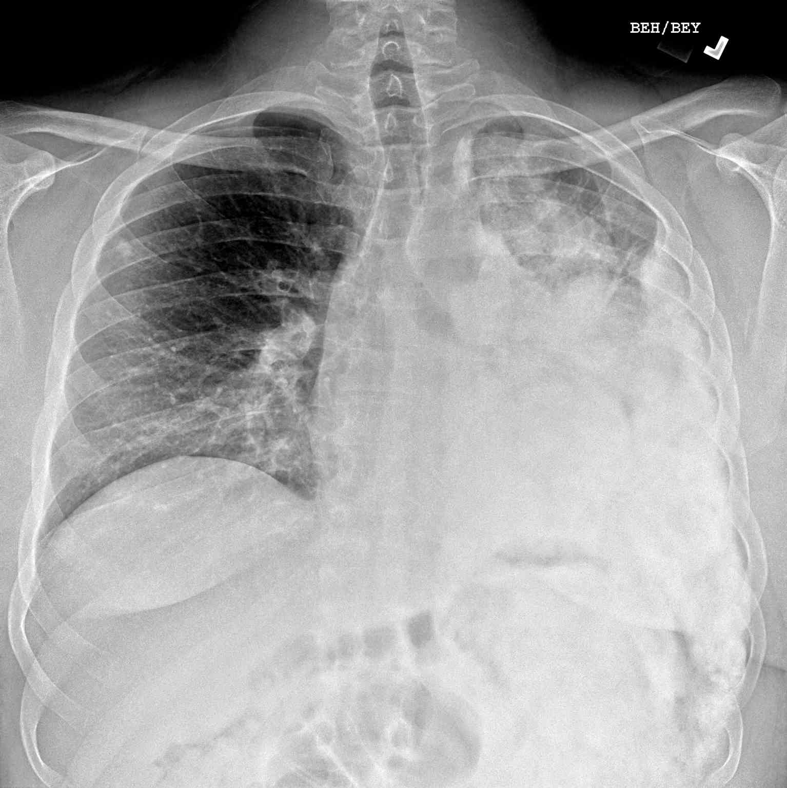 Chest Radiograph Osteosarcoma Mets