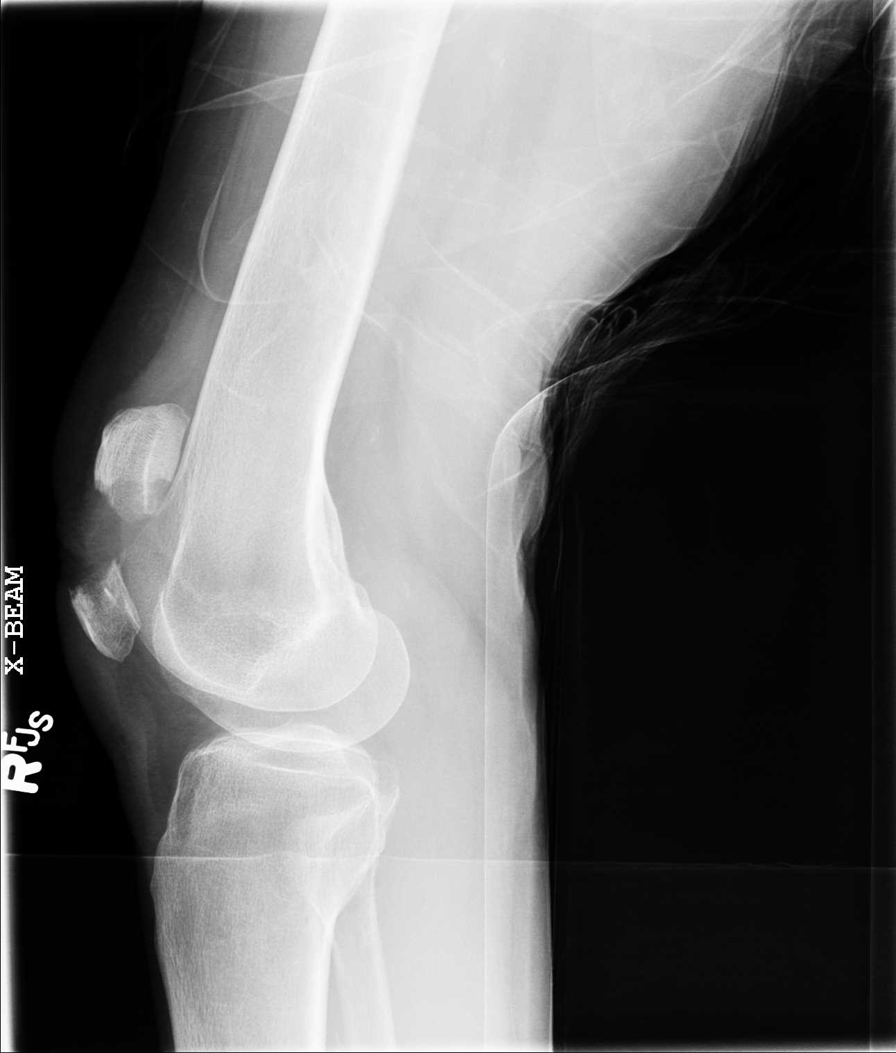<p>Knee Radiograph, Patellar Fracture</p>