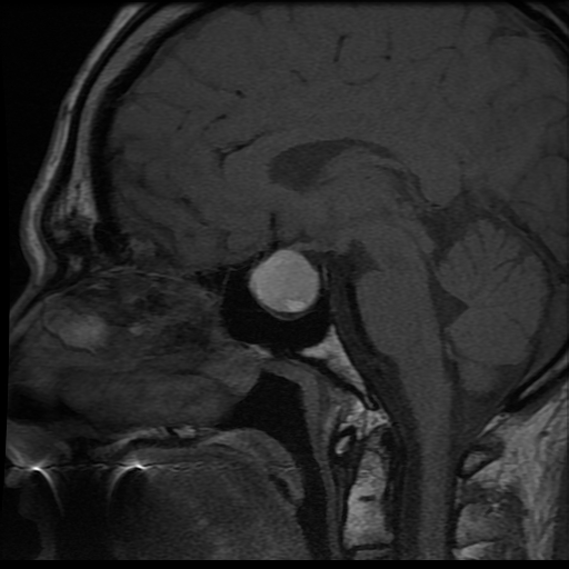 <p>MRI Head Sagittal T1 Pituitary Apoplexy</p>