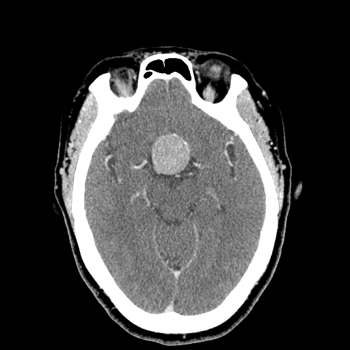 CT Head Pituitary Macroadenoma