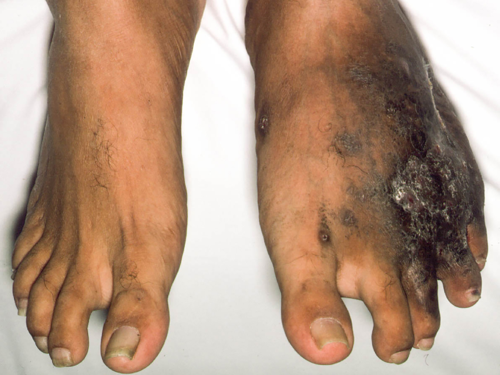 <p>Advanced-Stage Eumycetoma With Gangrenous Features