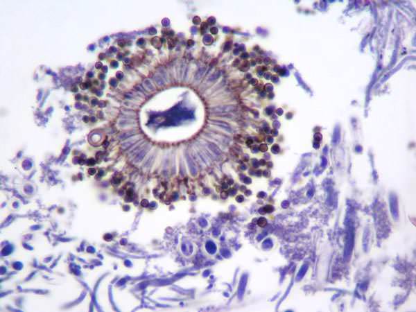 <p>Histopathological View of <em>Aspergillus niger