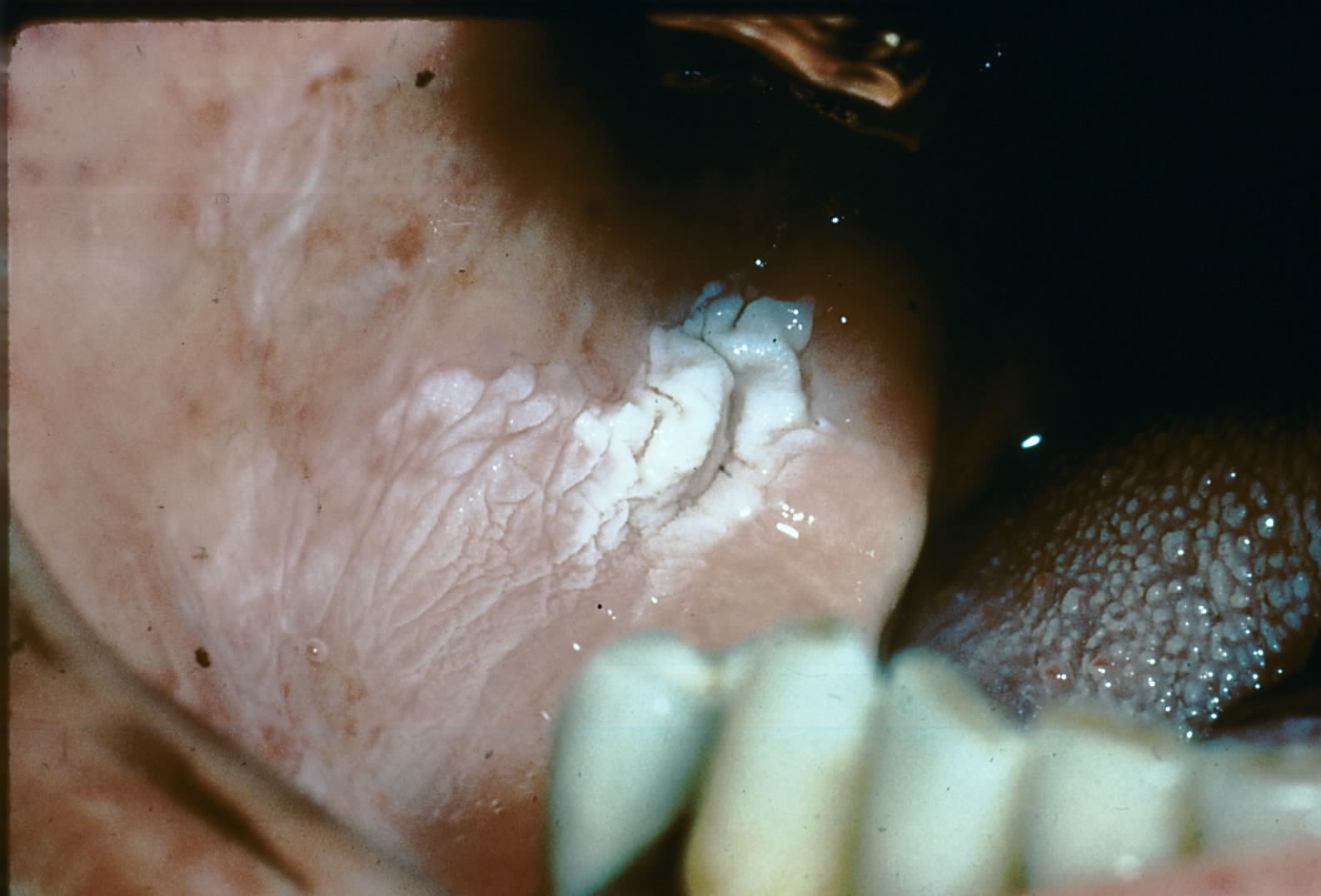 Photo of buccal vestibule exhibiting hyperkeratosis from smokeless tobacco.