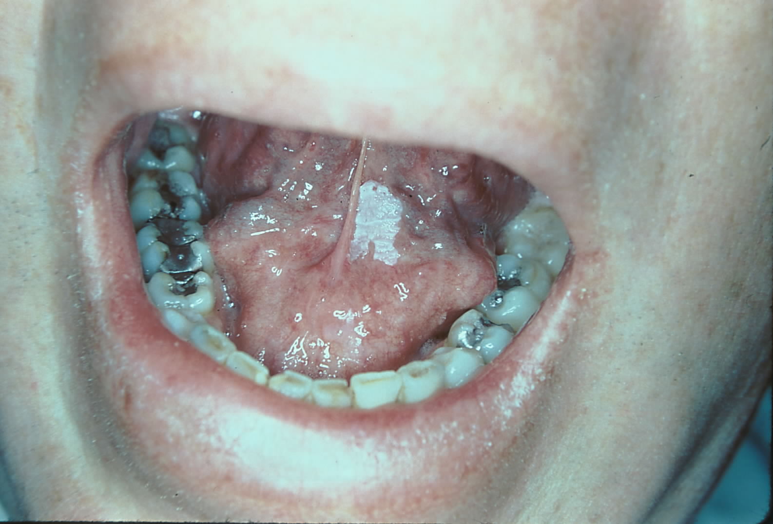 Image of the floor of the mouth with leukoplakia.