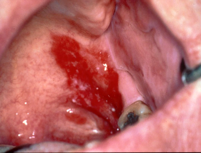 Image of erythrolakia extending through the posterior aspect of the mouth