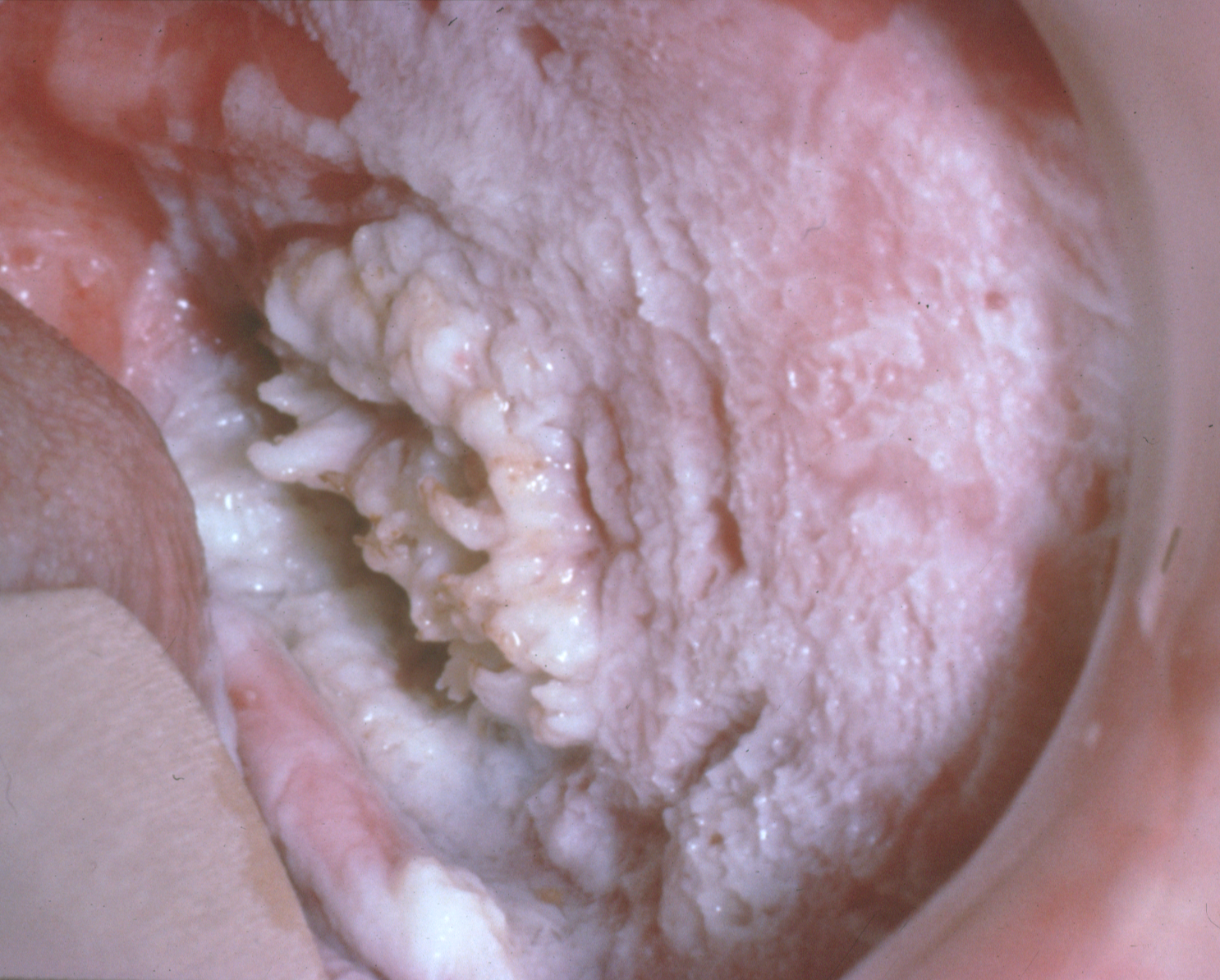 Photo of buccal vestibule exhibiting hyperkeratosis and verrucous carcinoma.