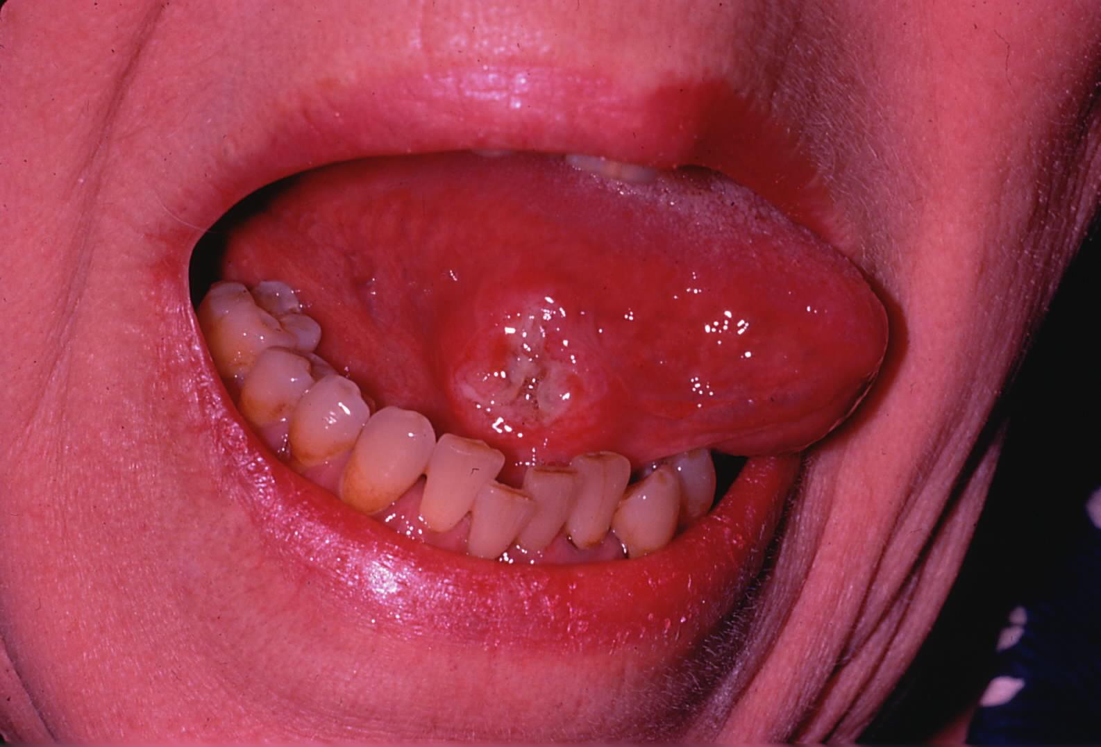 Image of the lateral border of the tongue with deep red, ulcerated lesion with rolled borders
