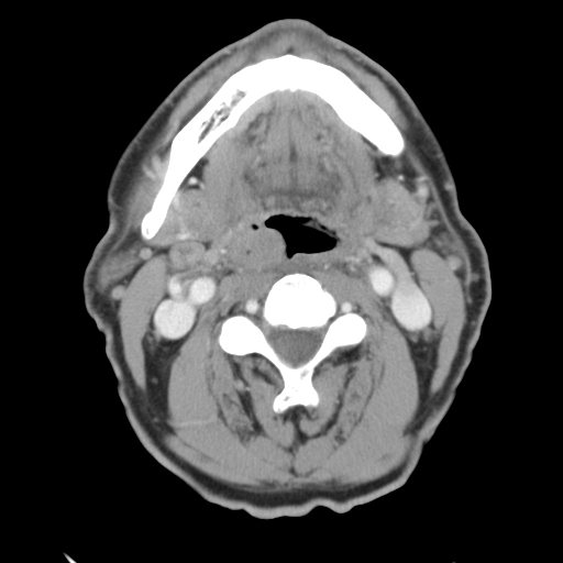 <p>Squamous Cell Carcinoma