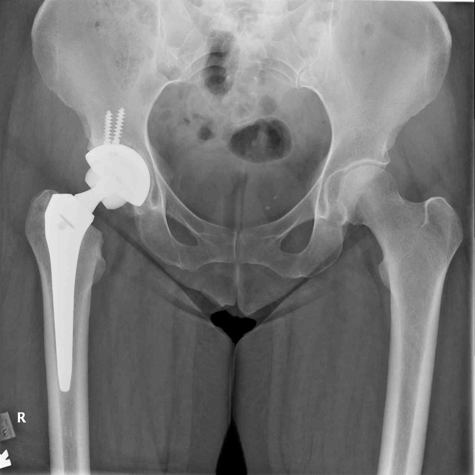 Pelvis Radiograph Right Hip Arthroplasty