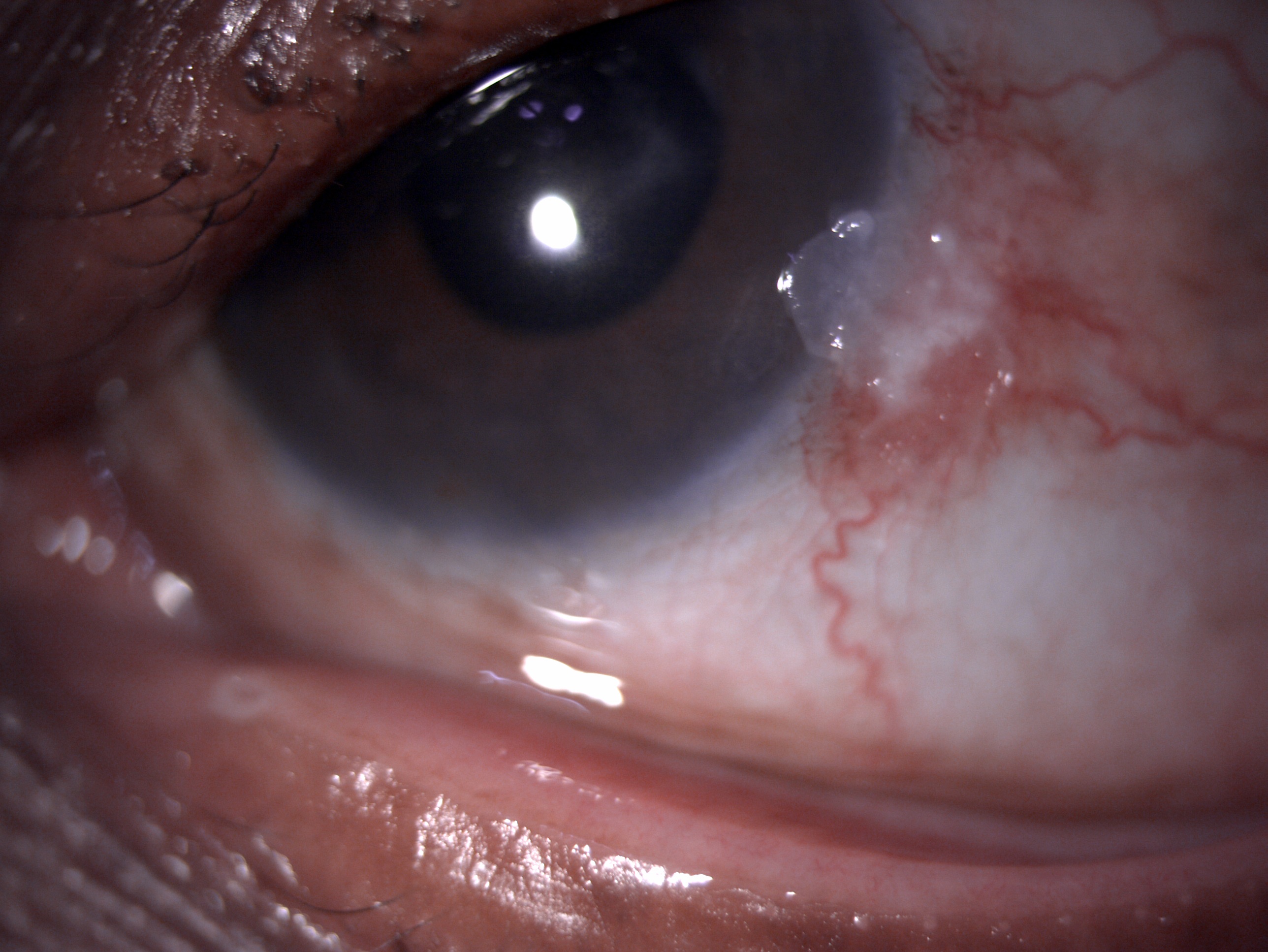 Slit lamp image of the patient depicting nasal whitish gelatinous conjunctivocorneal elevated plaque suggestive of ocular surface squamous neoplasia