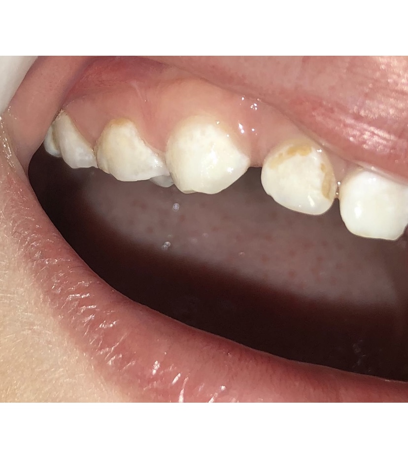 Active initial lesions (non-cavitated) and cavitated caries lesions in primary dentition.