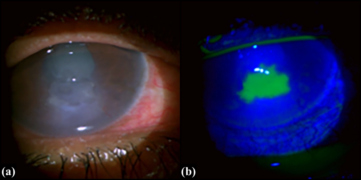 (a) Clinical photograph of an eye with persistent corneal epithelial defect (b) Epithelial defect seen after fluorescein stai