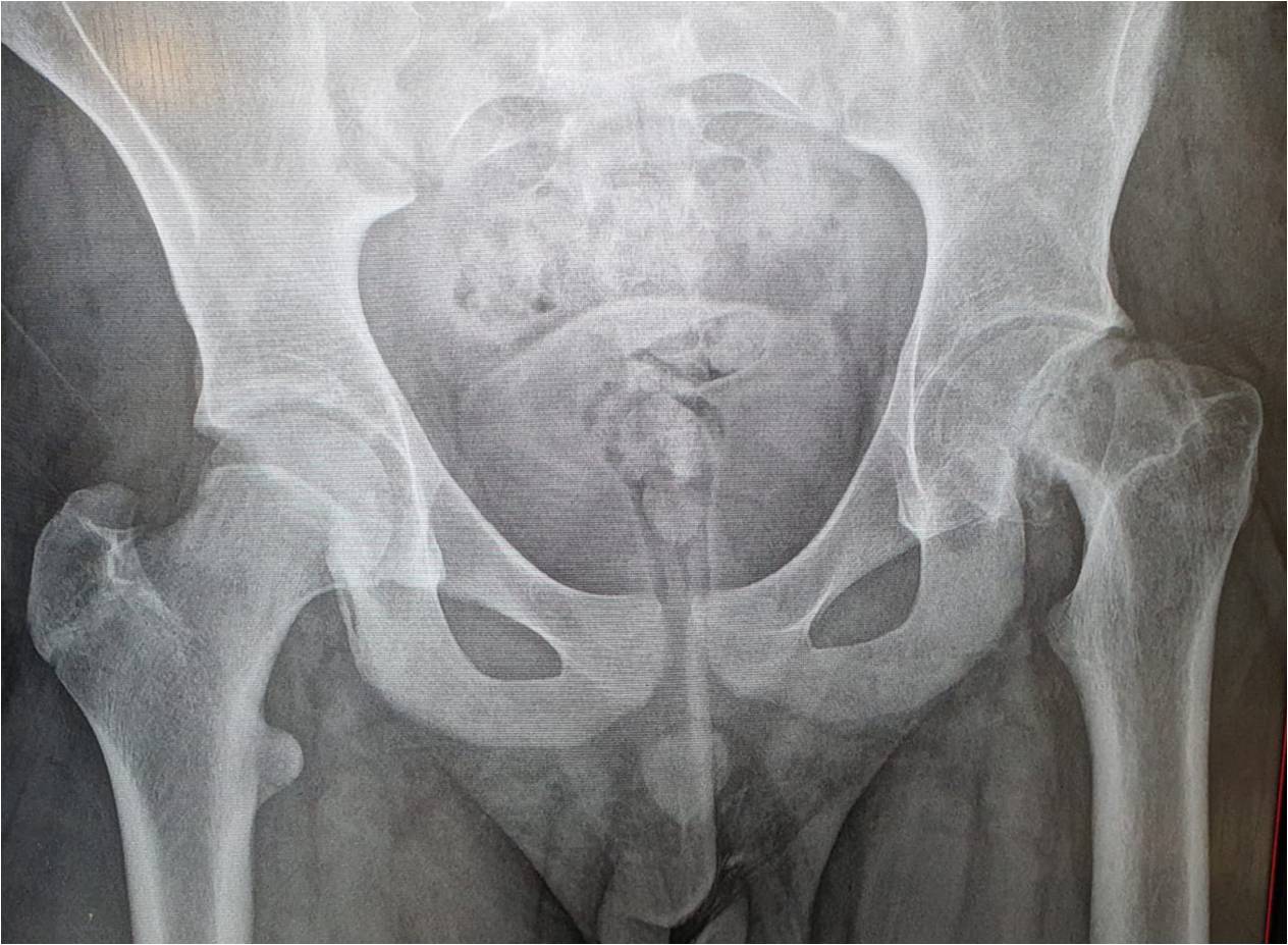 AP pelvis radiographs: There is a Left Slipped Capital Femoral Epiphysis