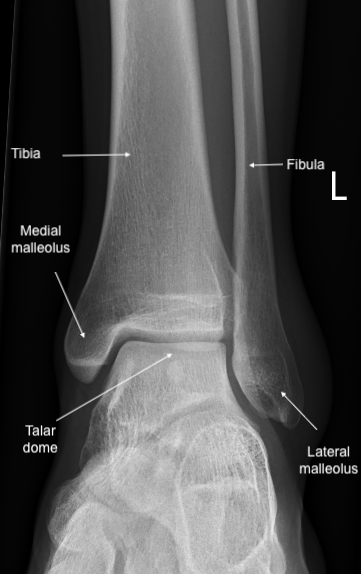 Anatomy of the ankle joint demonstated in anteropesterior X-ray of left ankle.