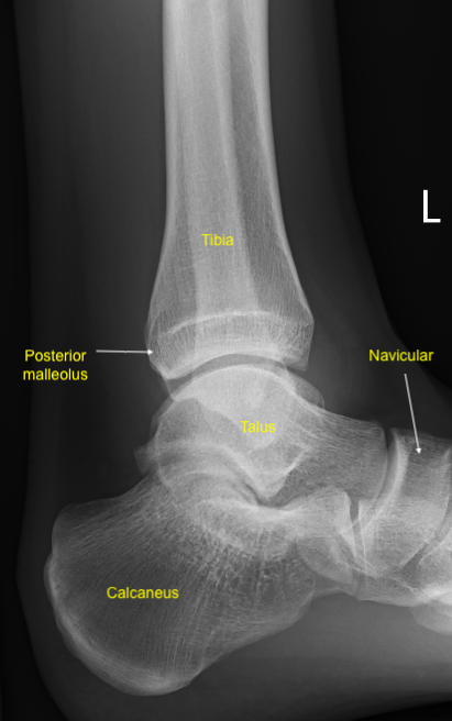 Ankle jonint anatomy on lateral X-ray of left ankle