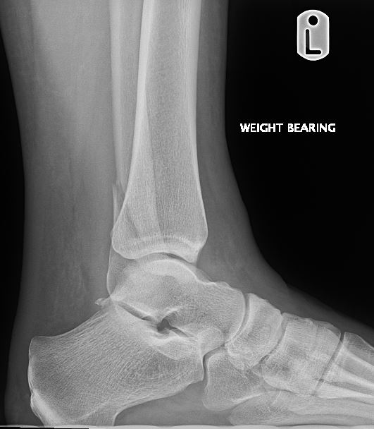Left ankle Lateral X-ray showing weber B fracture