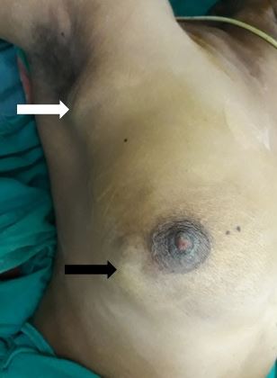 Ca breast with axillary lymphadenopathy