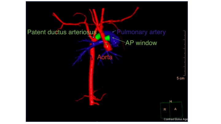 CT scan 3D reconstruction demonstrating an AP window.  There is also a large ductus arteriosus in the setting of severe coarctation.  