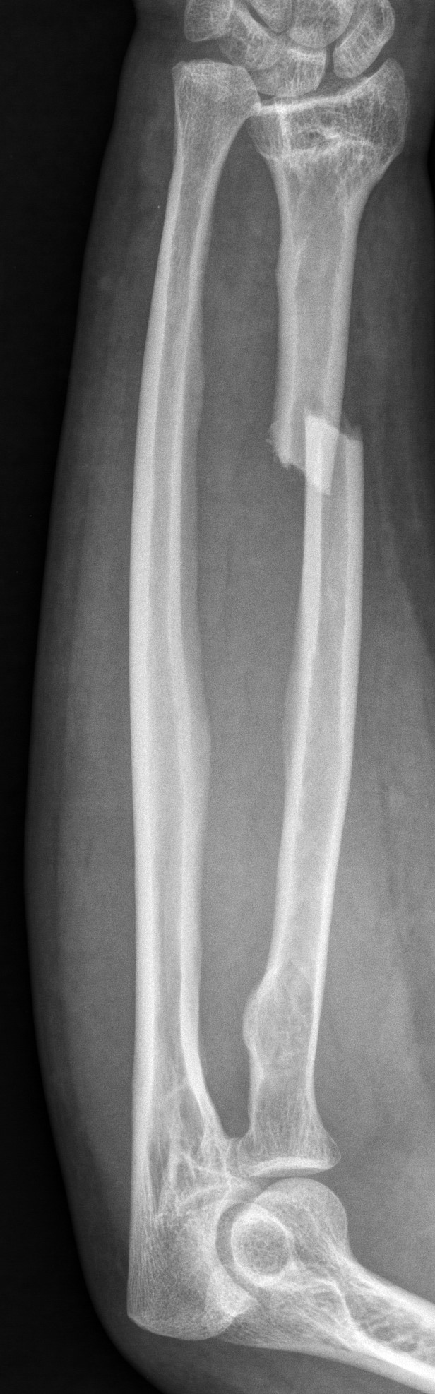 An x-ray of right forearm showing Galeazzi fracture-dislocation