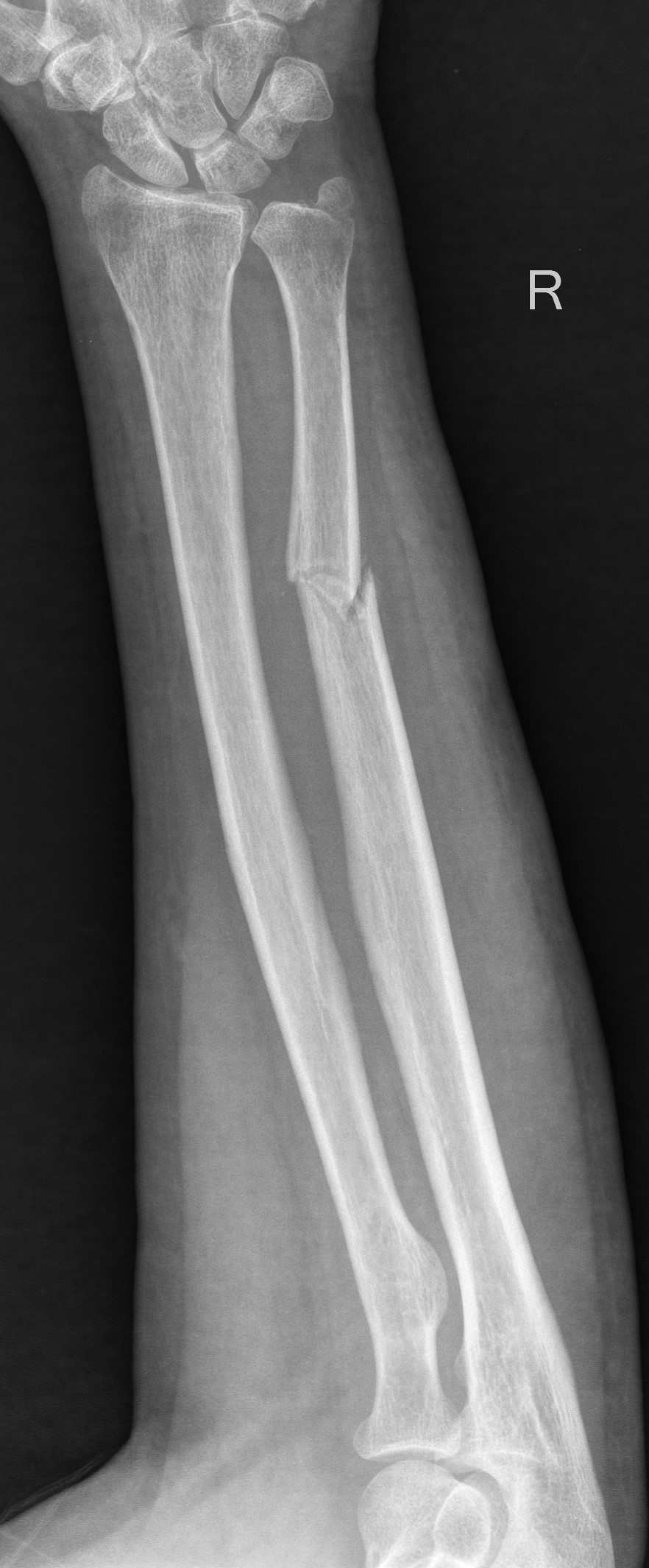 An x-ray of right forearm showing isolated ulna fracture