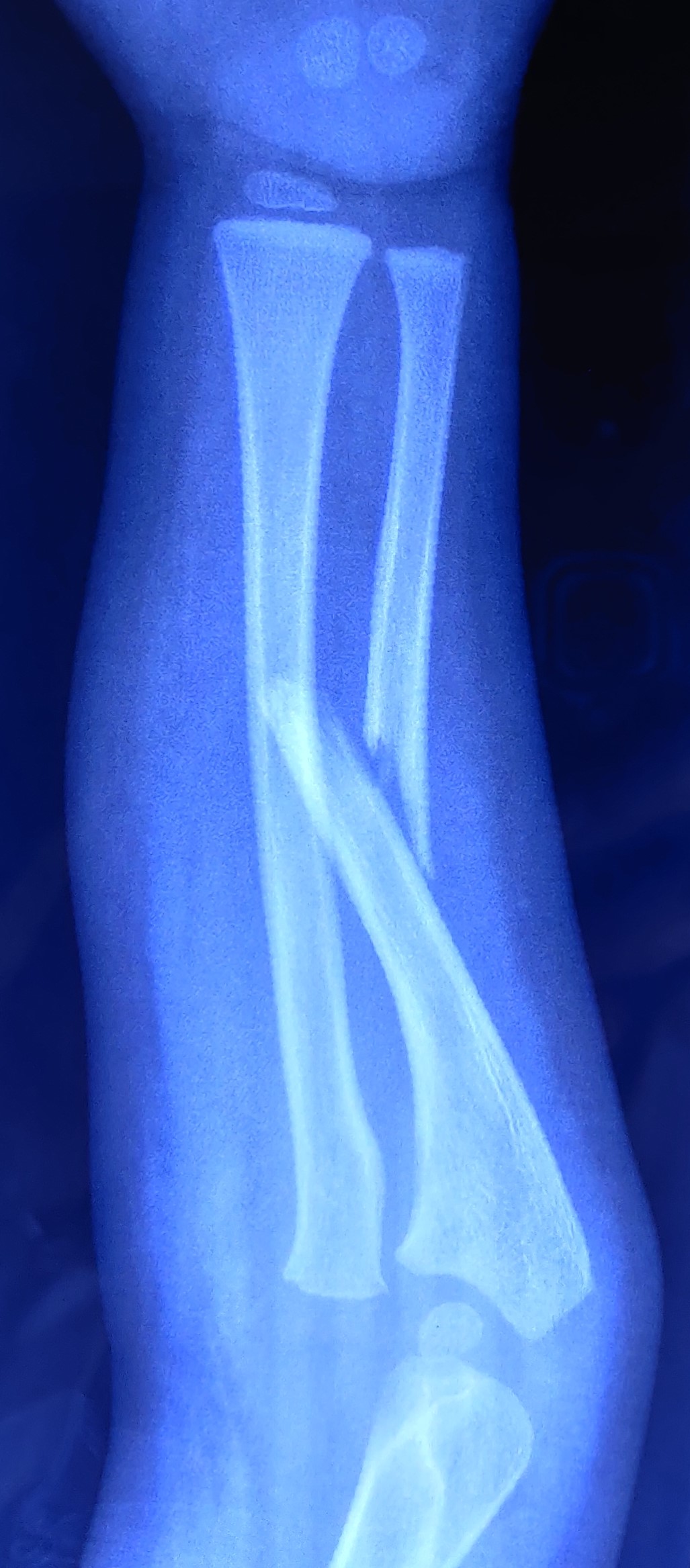 An x-ray of right forearm showing Monteggia fracture-dislocation