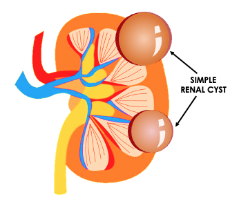 Simple Renal Cyst