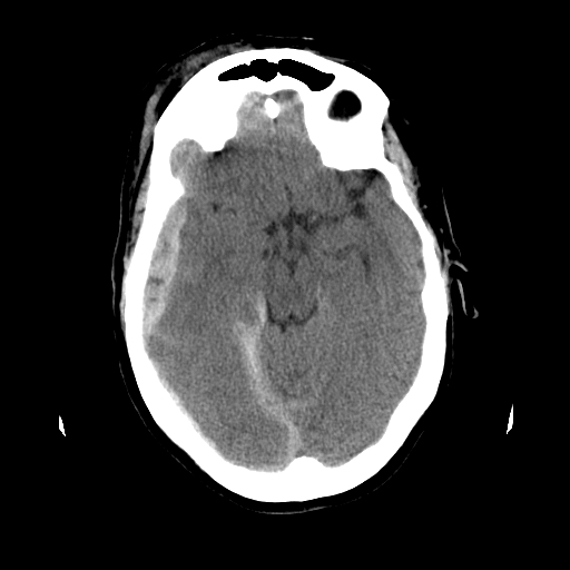 CT head subdural hematoma