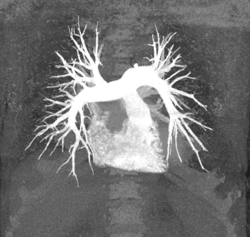 This is a 3D MIP (MaxIP) with the bone voxels removed showing contrast filling the lumens of the pulmonary arteries.