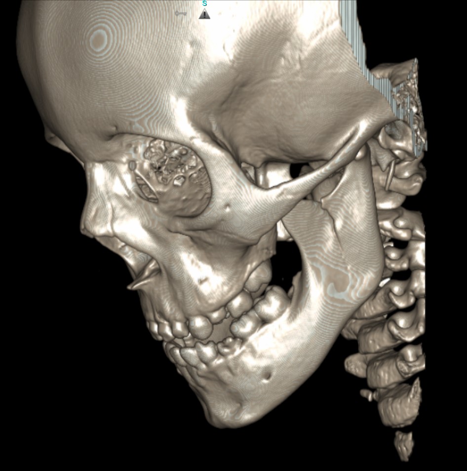 This is a 3D volume rendered image of the cortices of the face showing a mandible fracture.