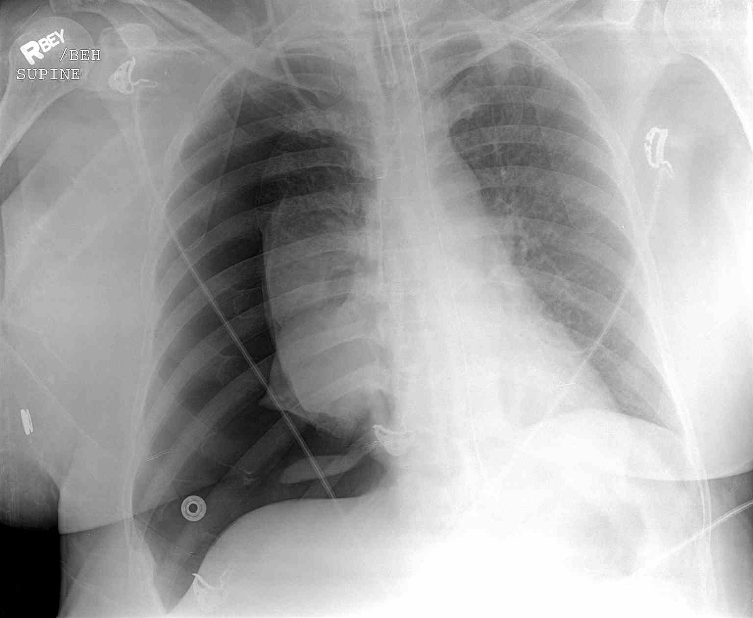 <p>Right Tension Pneumothorax&nbsp;Radiograph