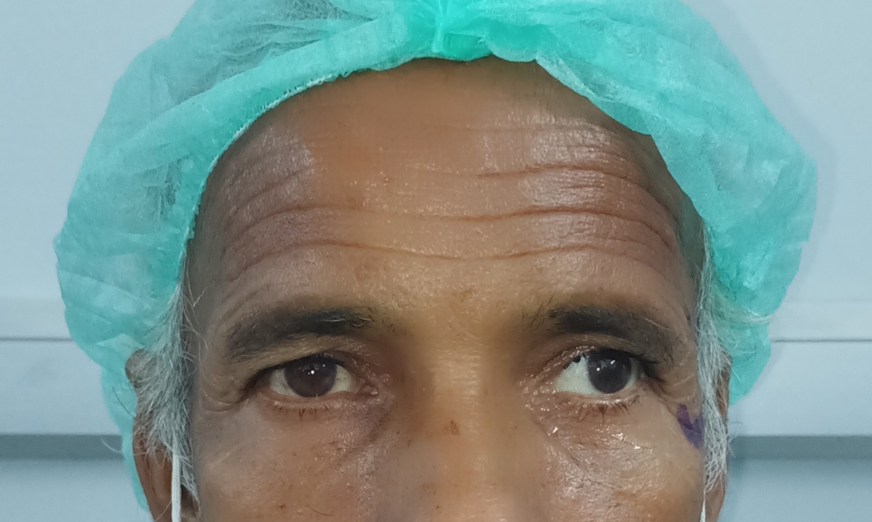 Image of  the patient depicting 20 degree exotropia along with 10 degree hypertropia in the left eye in primary gaze. Additionally, alternate cover test revealed right eye 20 degree exotropia with no vertical deviation suggestive of an alternate exotropia in both eyes with left eye dissociated vertical deviation