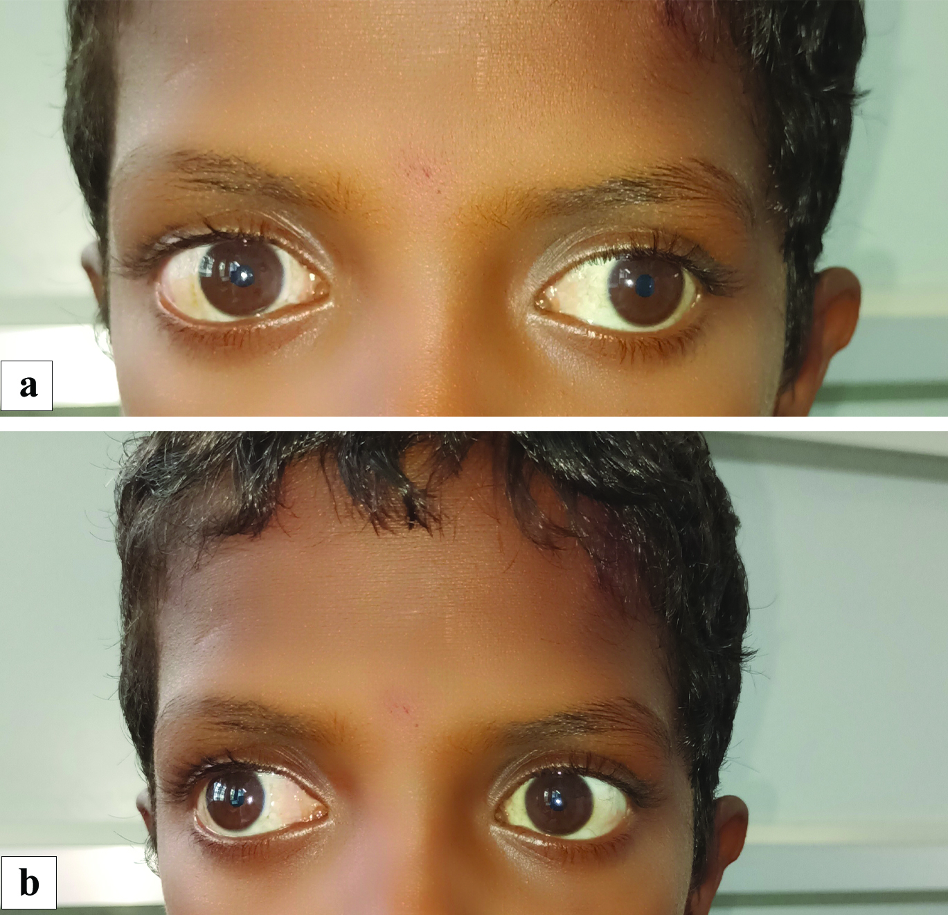 (a) Image of the child depicting 30 degrees exotropia in the left eye while fixating with right eye in primary gaze. (b) Image of the child depicting 30 degrees exotropia with minimal 5 degree hypertropia of the right eye while fixating with left eye in primary gaze suggestive of an alternate exotropia with right eye dissociated vertical deviation
