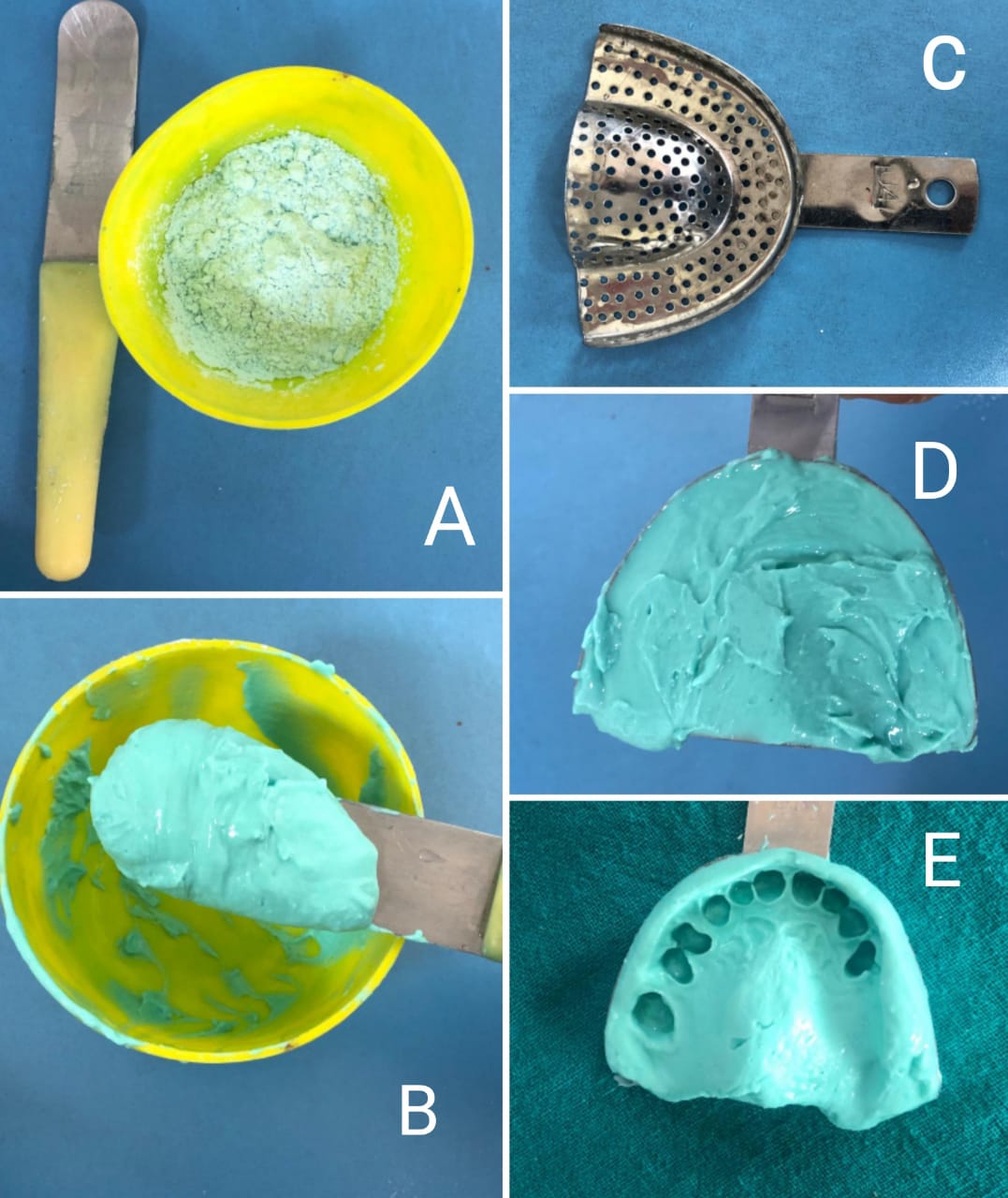 Fig3-  Mixing of alginate for impression making
A) Measured amount of alginate powder in a flexible rubber bowl and a curved