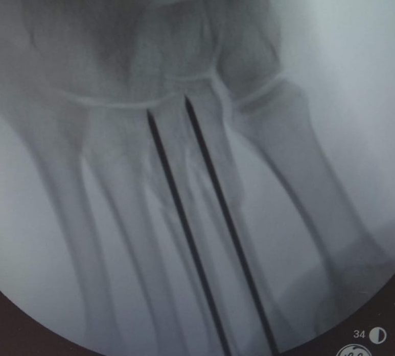 An x-ray of foot showing K-wire fixation for fracture 2nd and 3rd metatarsal shaft
