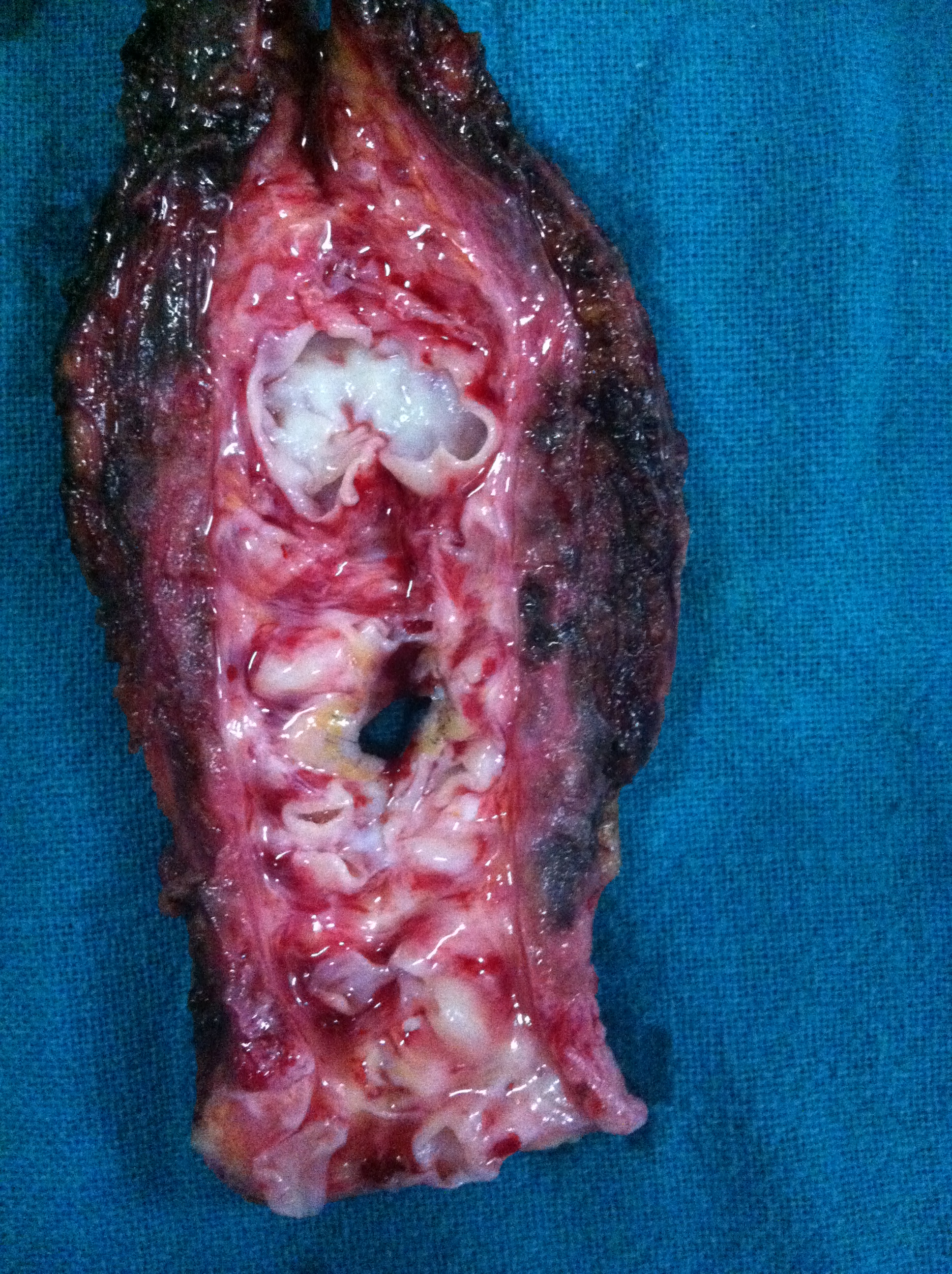 Scalp AVM (cirsoid aneurysm)