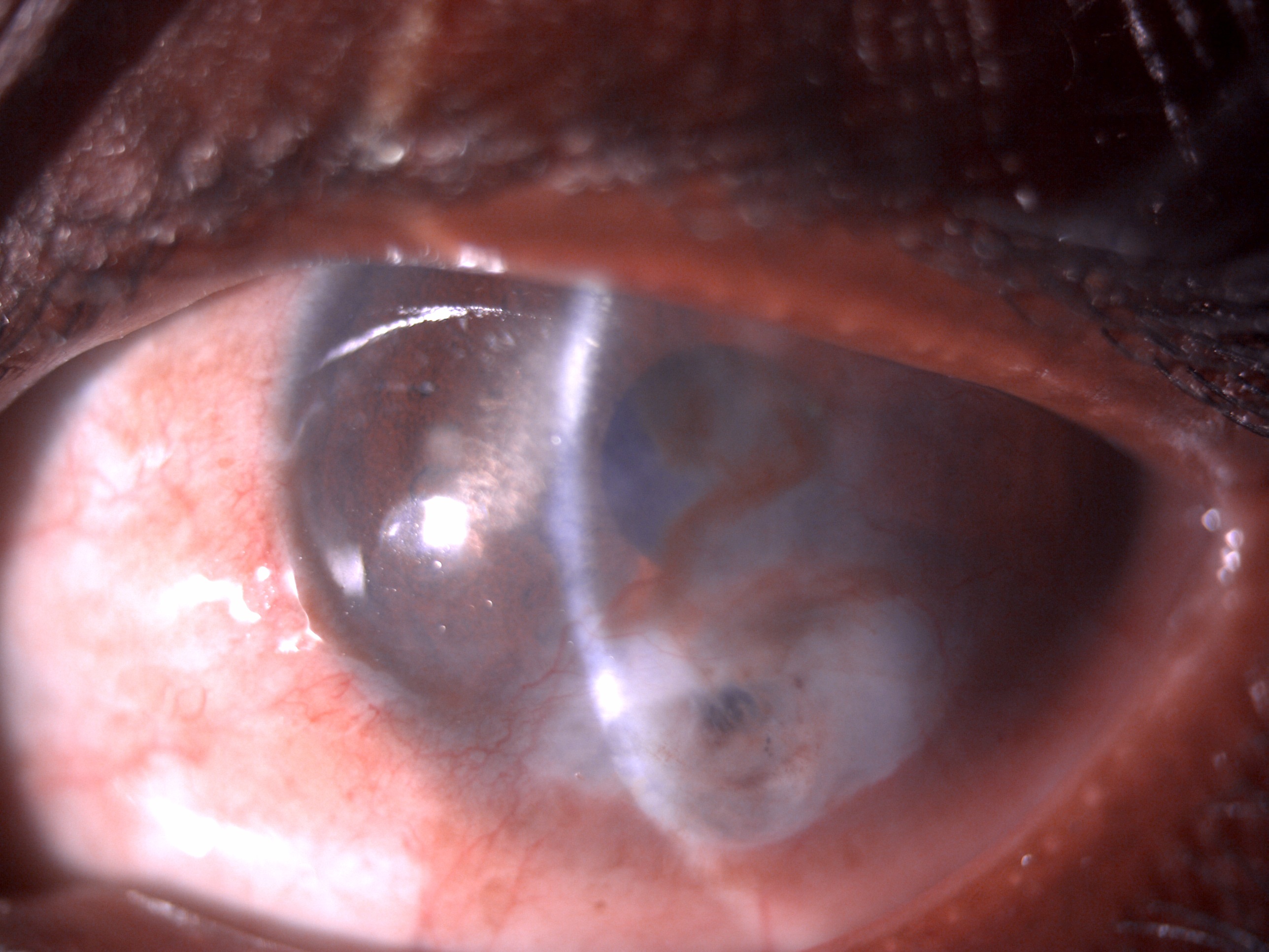 Slit image of the patient depicting conjunctival congestion, inferior localized epithelial bullae, superficial vascularizatio