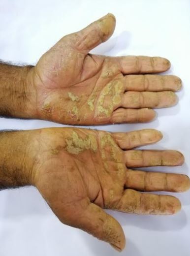 Palmoplantar psoriasis