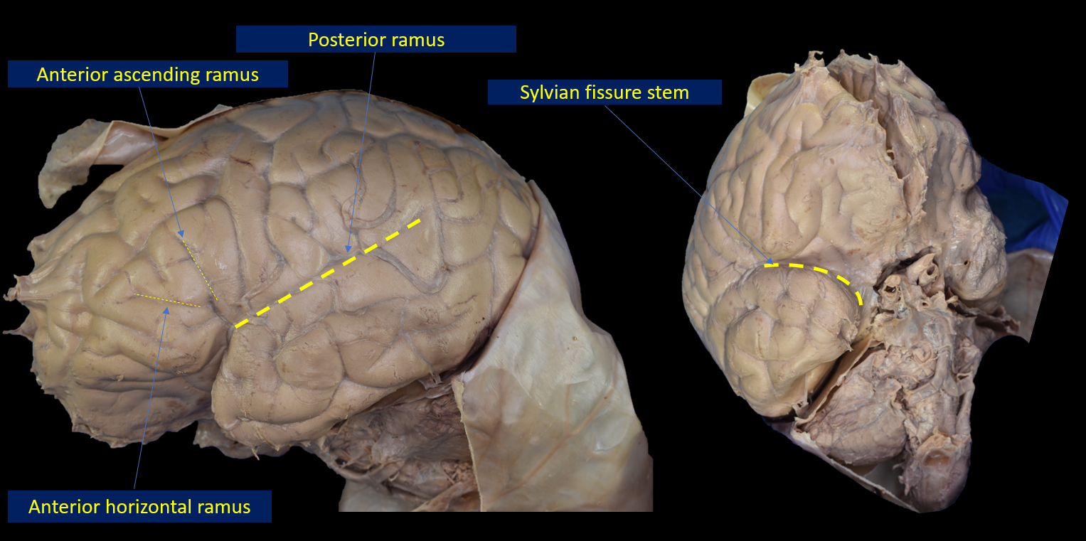 Figure 1. Superficial part of the Sylvian fissure covered by the arachnoid layer. The yellow dashed lines follow the stem (right image) and the rami (left image) of the superficial part of the fissure. The stem is located in the basal surface of the brain. It arises lateral to the anterior perforated substance, follows the sphenoidal ridge, and ends at the level of the pterion laterally. On the lateral surface of the brain, the stem is divided into three rami, the posterior ramus that is the continuation of the fissure between the frontoparietal and the temporal opercula, the anterior ascending ramus between the pars opercularis and the pars triangularis, and the anterior horizontal ramus between the pars triangularis and the pars orbitalis. 