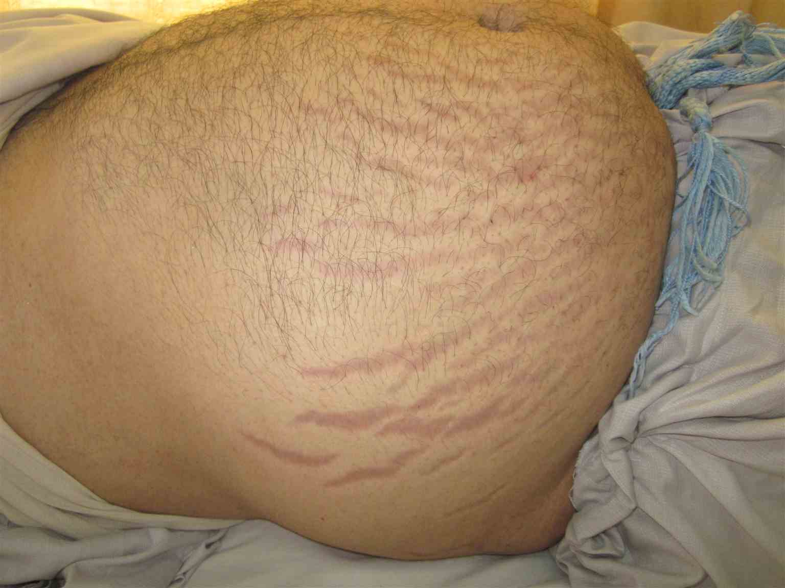 Vertical purplish abdominal striae in a patient with Cushing syndrome