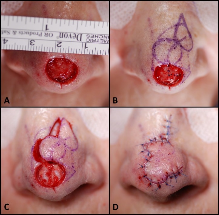 Bilobed flap, Zitelli modification. A) 1.5 cm defect of nasal tip. B) Superolaterally-based bilobed flap marked. C) Residual tissue in defect removed, flap incised and elevated in a submuscular plane; note the cartilages of the nasal tip that were not previously visible. D) Flap inset with deep dermal and superficial sutures.