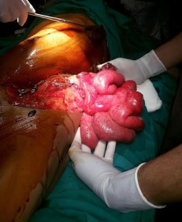 Evisceration due to penetrating abdominal injury
