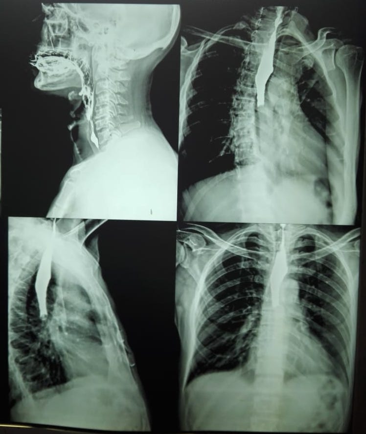 <p>Esophageal Radiography With Contrast