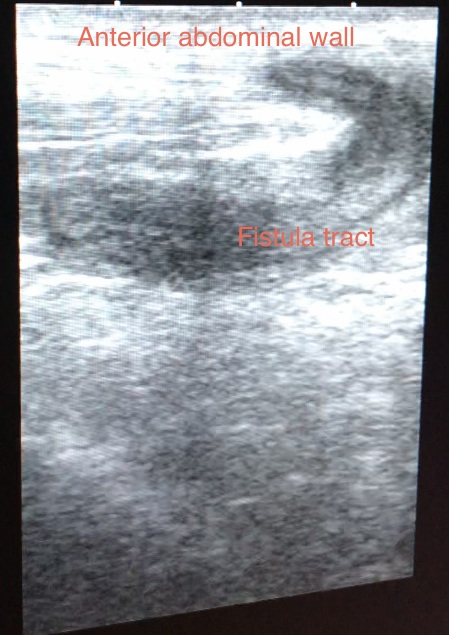 <p>Periumbilical Fistula Ultrasonography